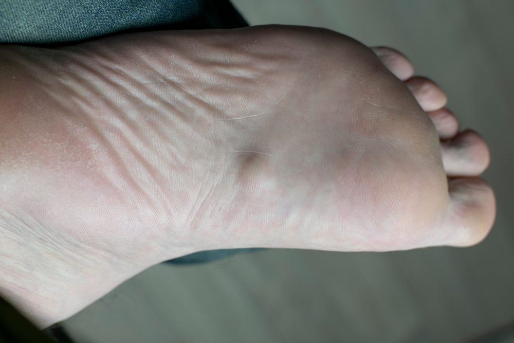 plantar fibroma